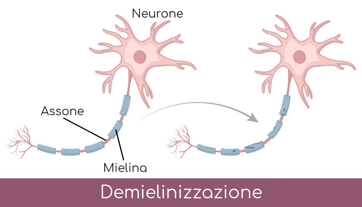 demielinizzazione