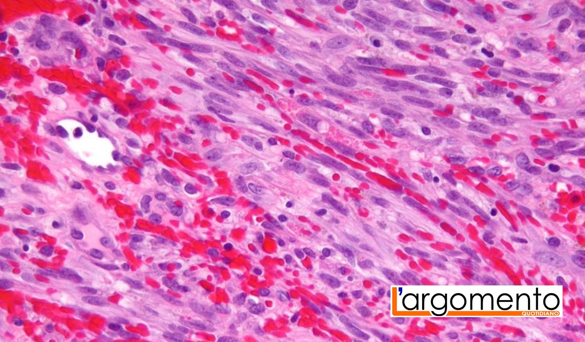 Il sarcoma di Kaposi
