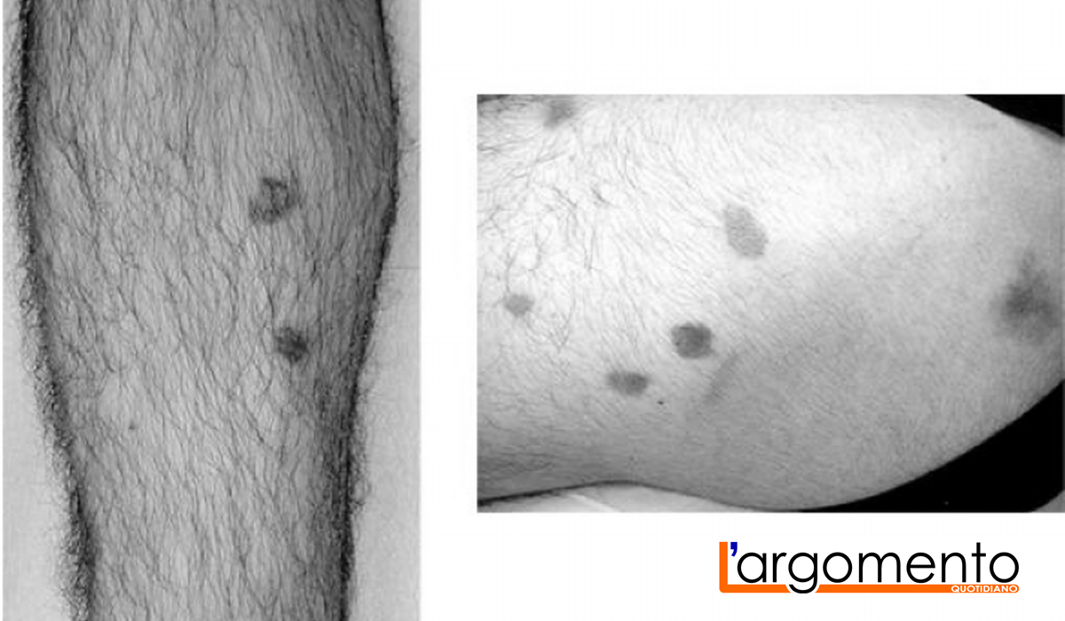Il sarcoma di Kaposi