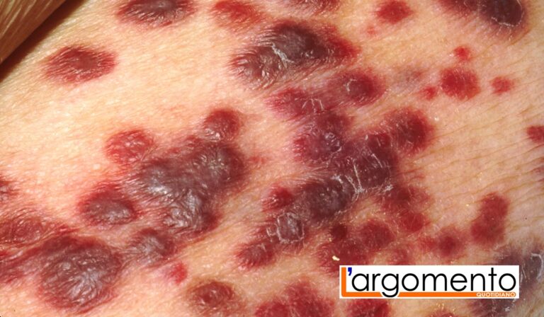 Sarcoma di Kaposi