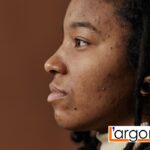 Acne cistica: rimedi, cura definitiva, cause