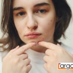 Brufoli sul mento: cause, come eliminarli, ormoni, rimedi naturali