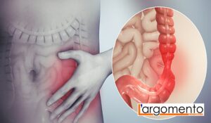 colon irritabile