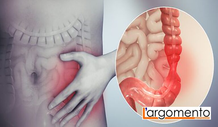 colon irritabile