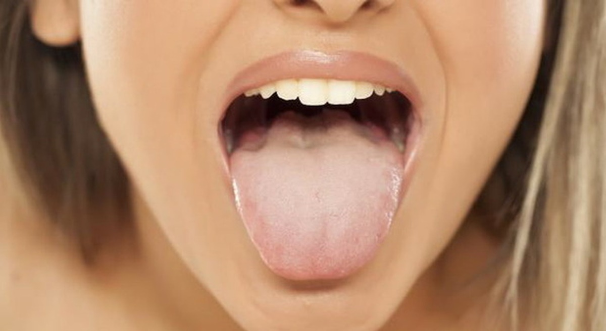lingua bianchissima