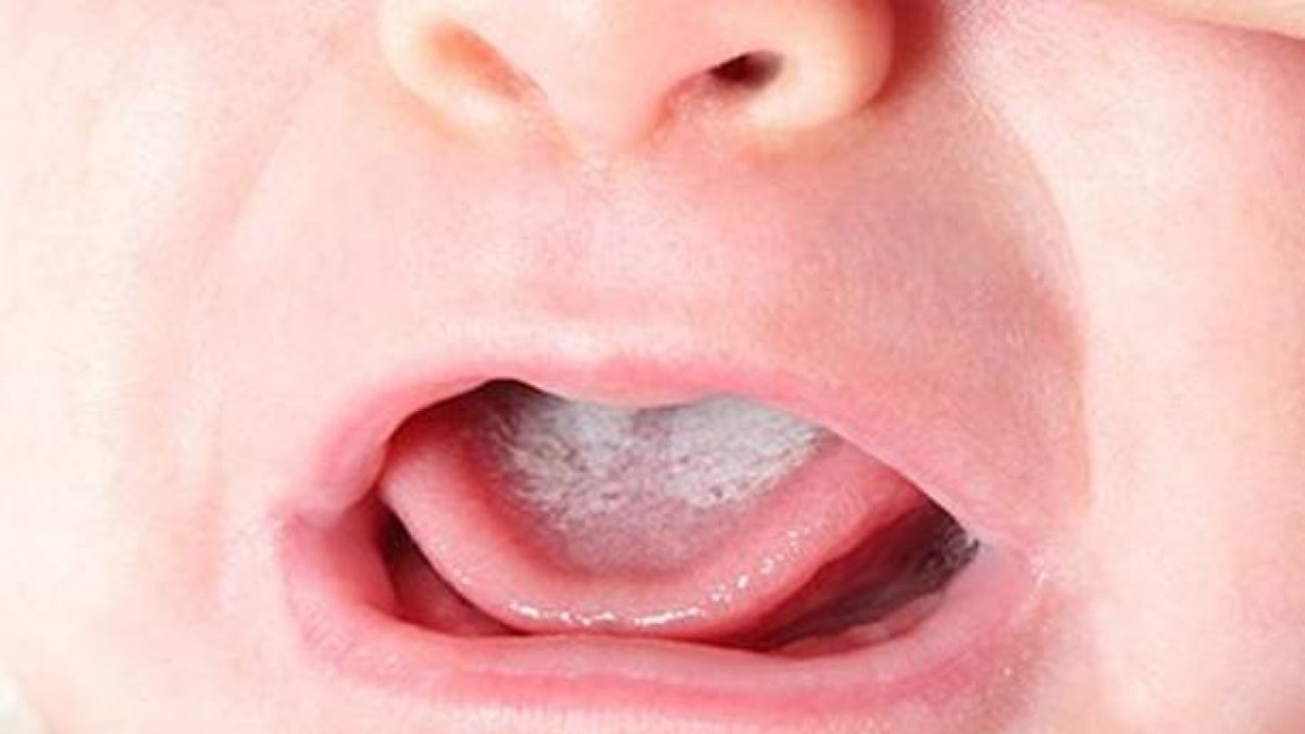 lingua bianchissima