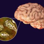 Ameba mangia-cervello: cos’è, sintomi, sopravvivenza, da dove si prende