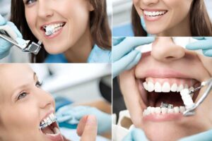 Bonus Dentista Come Ottenere l'Apparecchio Gratuito