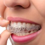 Apparecchio trasparente per denti dritti: cos’è, come funziona e cosa sapere