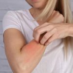Orticaria da stress e alimentazione: quali cibi possono peggiorare i sintomi